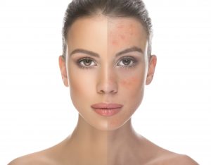 rosacea-triggers-to-avoid